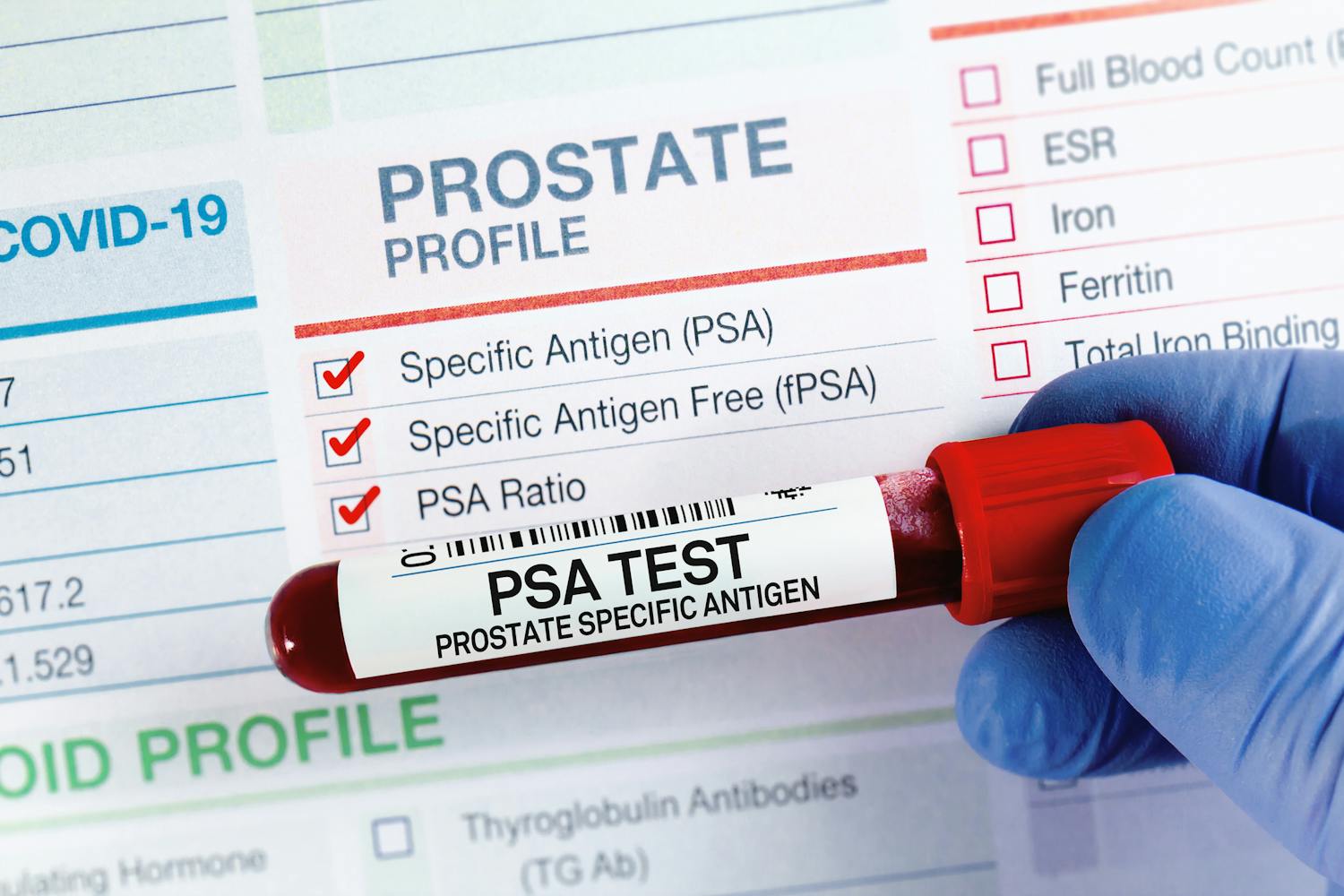 Prostate : pourquoi faut-il surveiller son taux de PSA ?